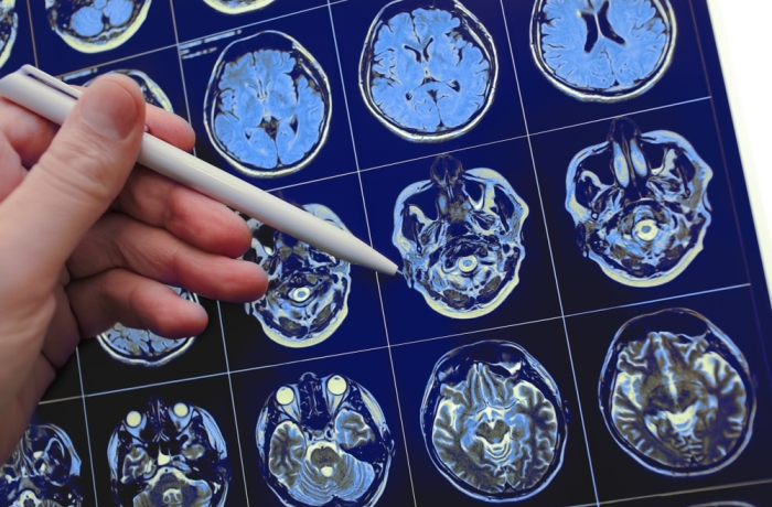 Medical doctor pointing with pen to the brain poblem on the MRI study result.